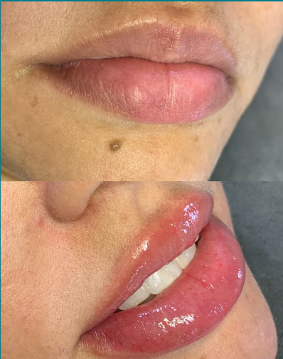 Antes e depois de volumização labial, lábios mais hidratados e desenhados